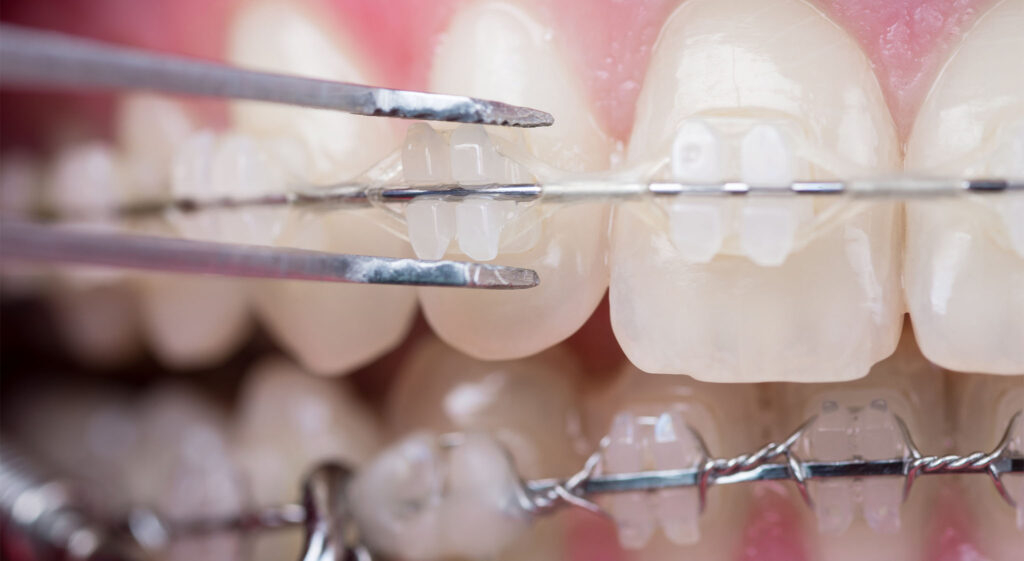 Dentist checking up teeth with ceramic brackets, using reverse tweezers at the dental office. Macro shot of teeth with braces. Orthodontic Treatment. Dentistry